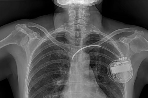 X ray pacemaker 596x330
