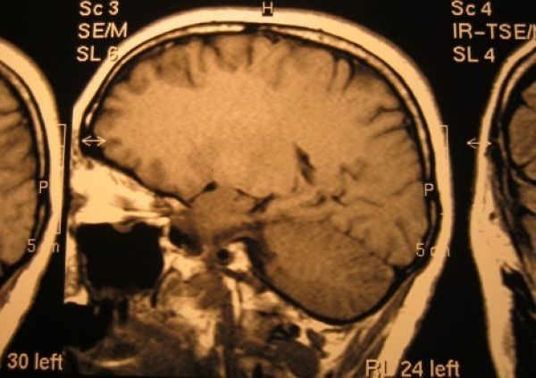 Brain scan cropped 2 468x330