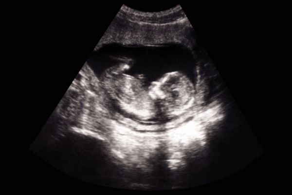 Fetal scan
